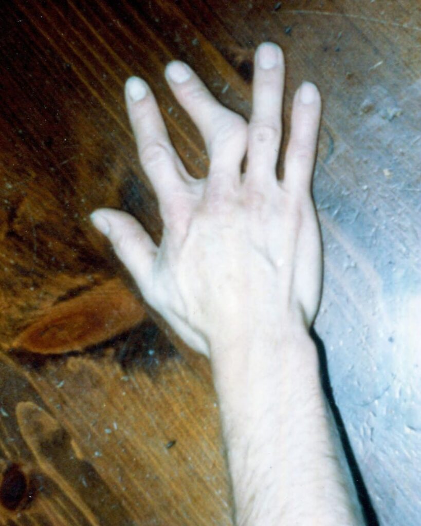 fingers affected by CATSYL gene mutation